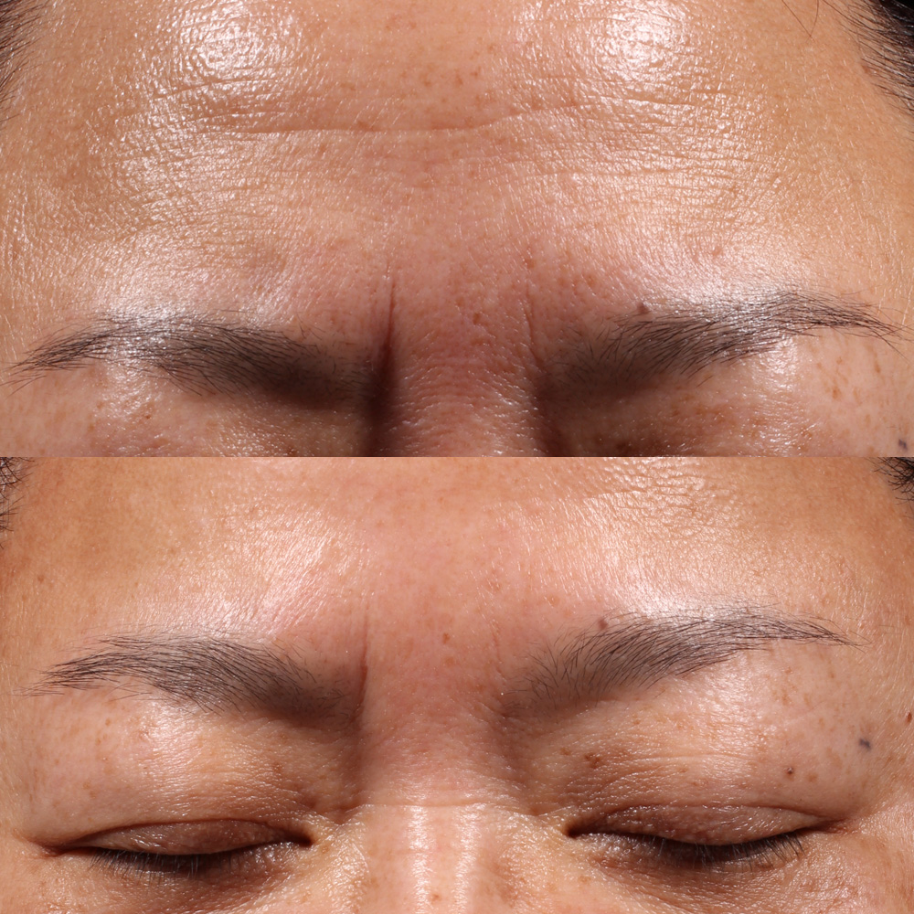 Bild på resultat efter NEOSTRATA Retinol peel