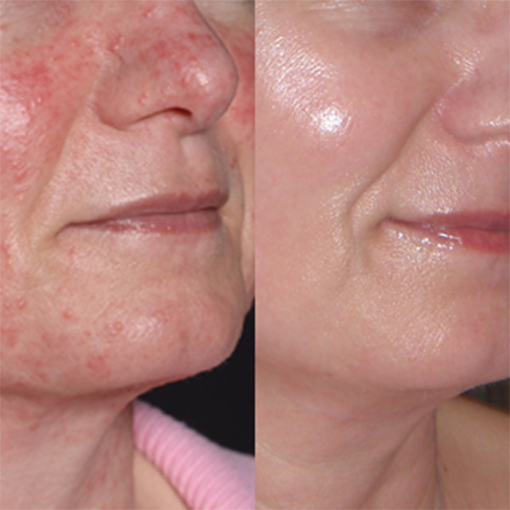 Bild på kvinna med Rosacea, före och efter en NEOSTRATA-behandling.